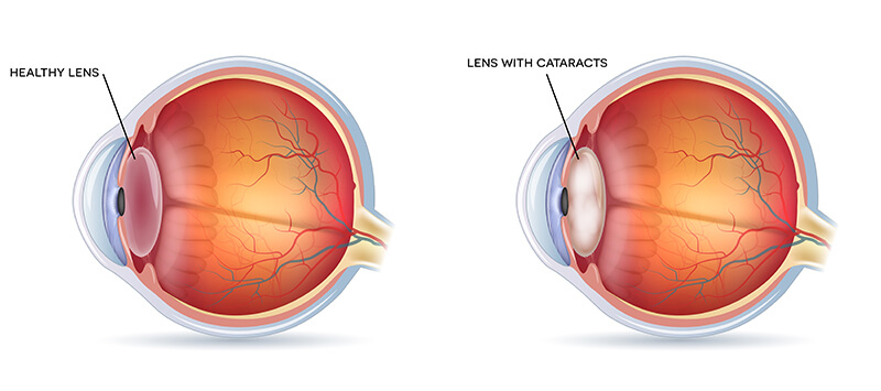 Chart showing a healthy eye compared to one with a cataract