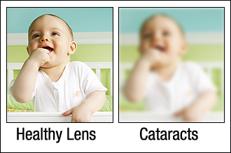 Example of Vision Through A Cataract