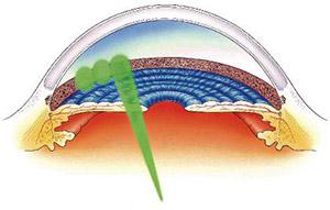 Trabeculoplasty Diagram