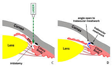 Iridotomy Diagram