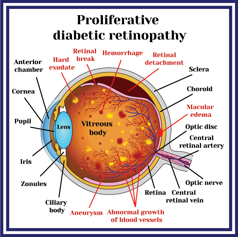 Medical Illustration of Proliferative Diabetic Retinopathy