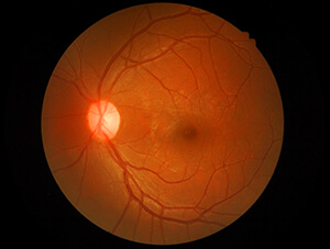 Photo of A Normal Macula