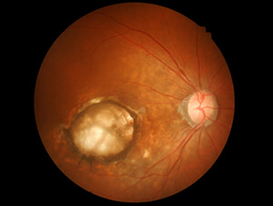 Dry Macular Degeneration with Geographic Atrophy