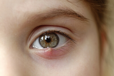 Stye Treatment in West Palm Beach