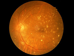 Macular Degeneration with Drusen