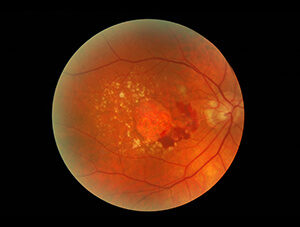 Wet Macular Degeneration with Fluid Under the Macula.