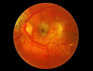 Wet Macular Degeneration with scar tissue formation.