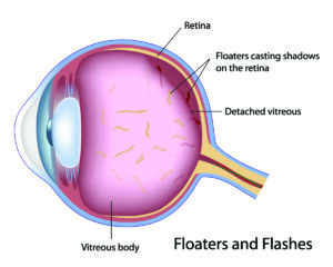 eye floaters and flashes