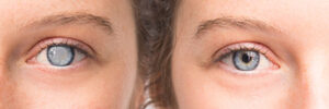 Laser Cataract Surgery West Palm Beach