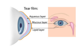 dry eye treatment West Palm Beach 