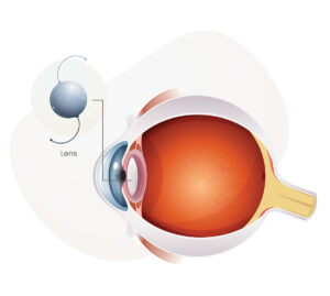 Refractive Lens Exchange in West Palm Beach