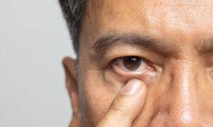 Glaucoma West Palm Beach